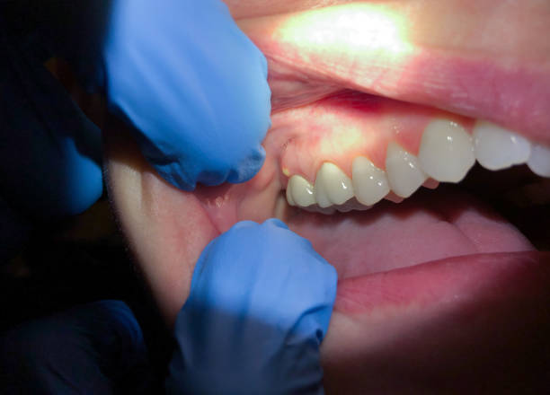 Best Dental Abscess Treatment in Pacifi, CA